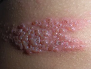 Shingles