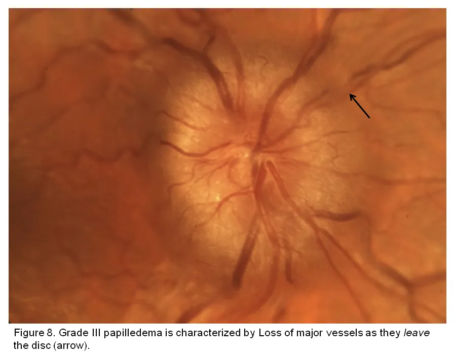 Papilloedema fundoscopy