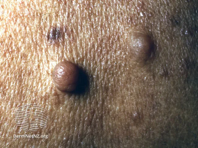 Cutaneous neurofibromas