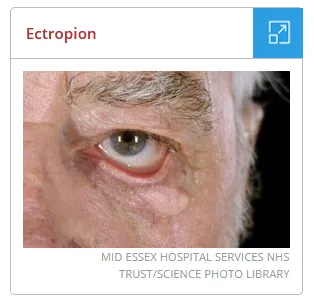 Ectropion