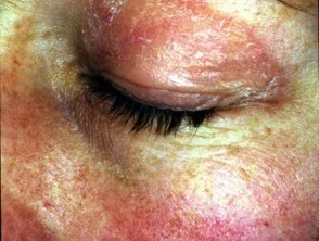 Dermatomyositis