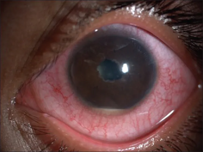 Hypopyon anterior uveitis