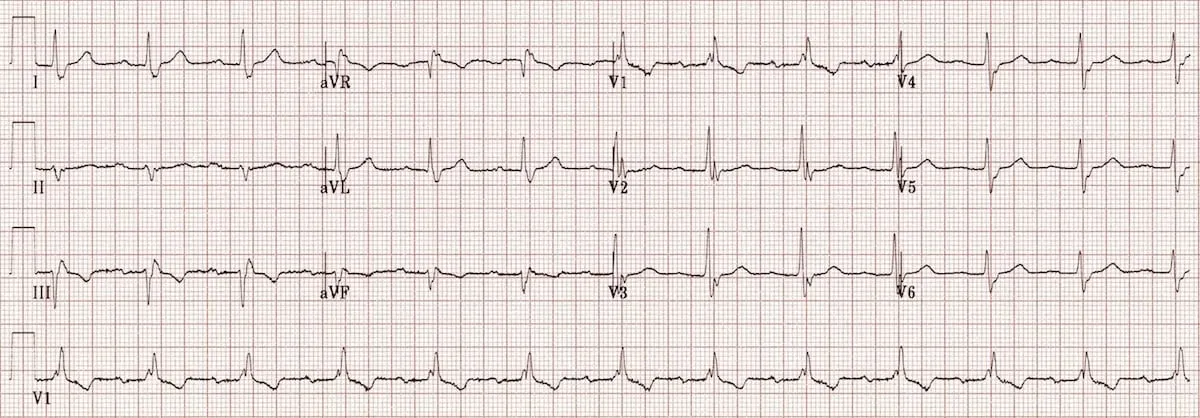 Trifascicular block — RBBB with left axis deviation
