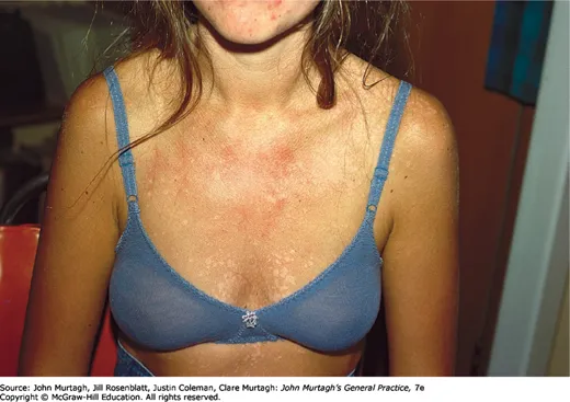 Pityriasis versicolor — hypopigmented scaly patches on tanned skin