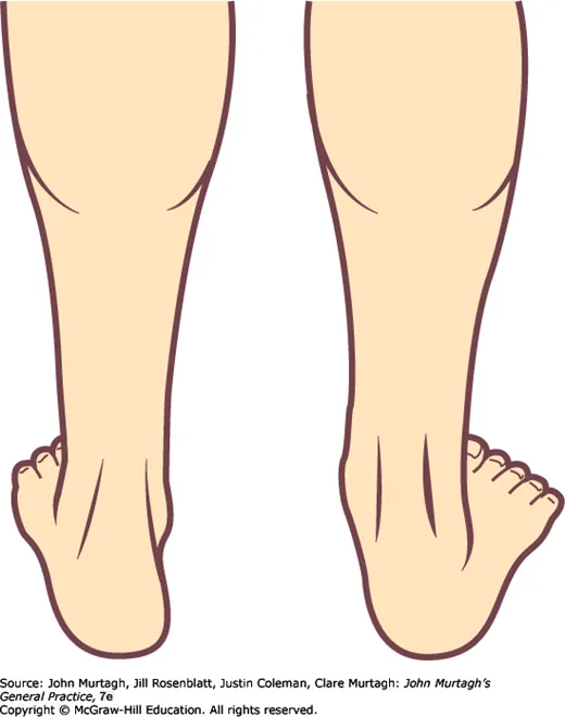 Too many toes sign — tibialis posterior rupture