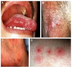 Behcet syndrome