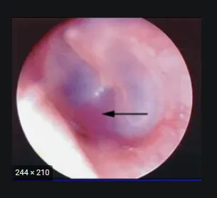 Otosclerosis examination findings