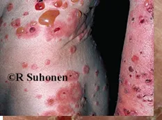 Bullous pemphigoid