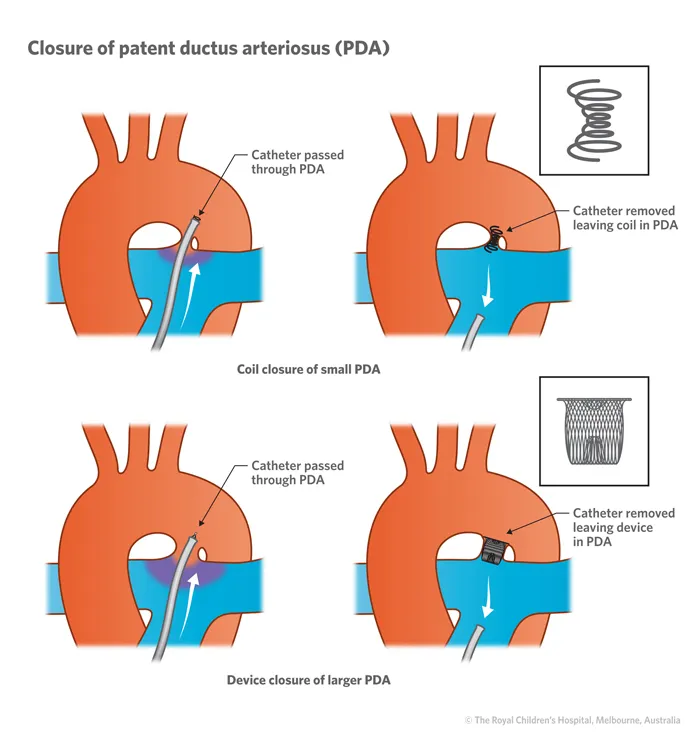 PDA anatomy