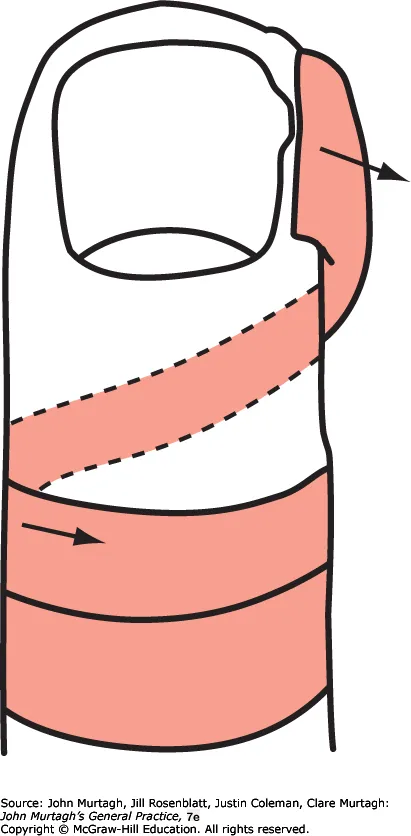 The spiral tape method for the ingrowing toenail