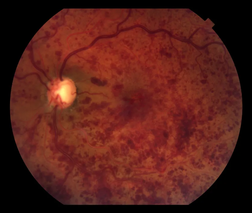 Central retinal vein occlusion — further example