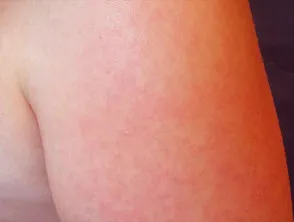 Fifth disease