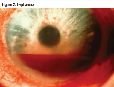 Hyphaema