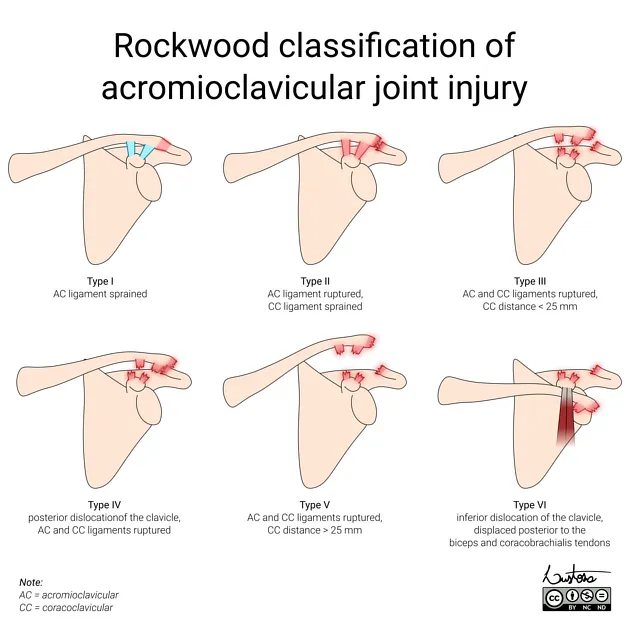 Rockwood classification of AC joint injury