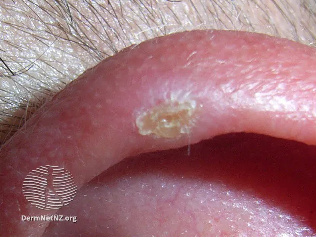 Chondrodermatitis