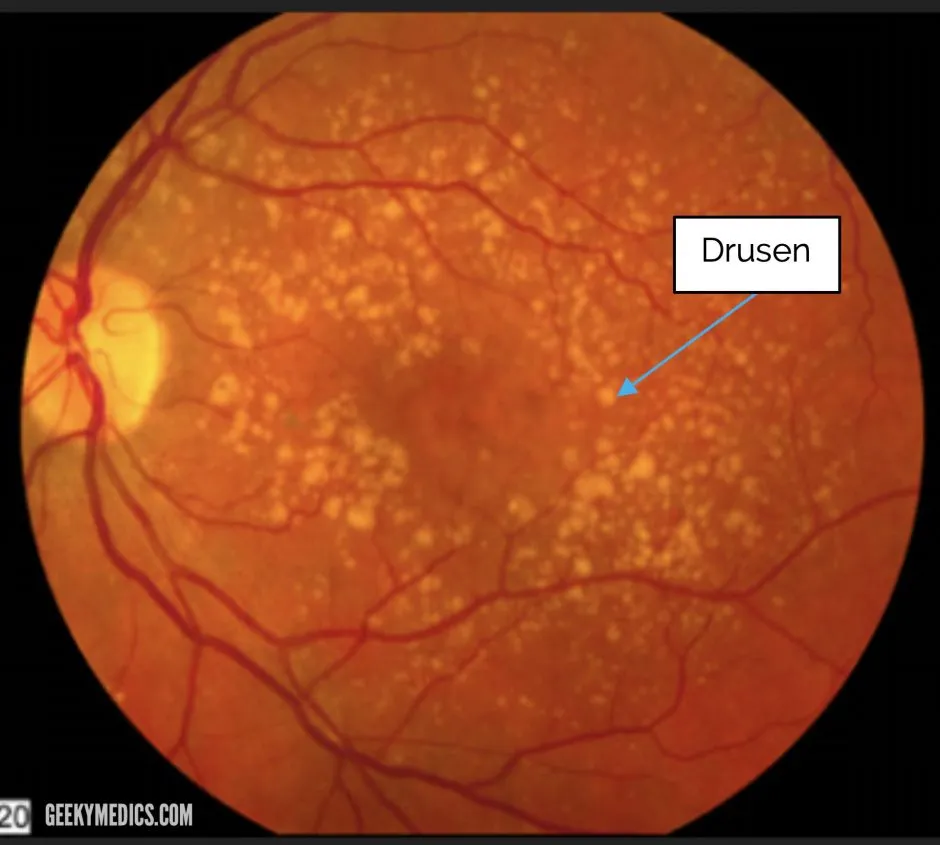 Drusen in age-related macular degeneration