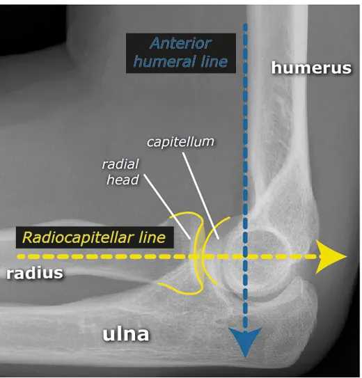 Anterior humeral line