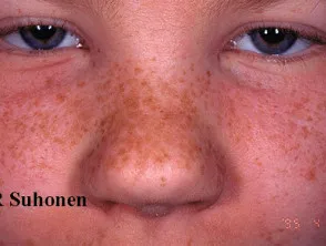 Freckles