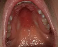 Erythematous candidiasis