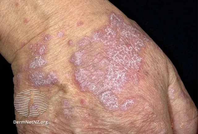 Lichen planus