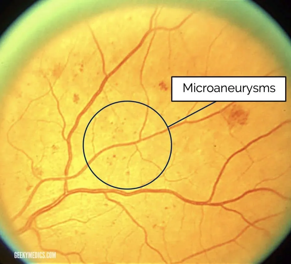 Microaneurysms in diabetic retinopathy