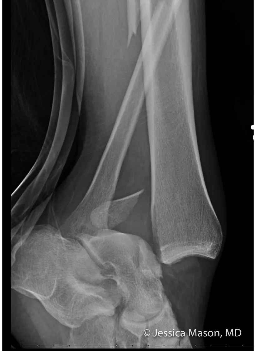 Bimalleolar fracture — both medial and lateral malleoli fractured