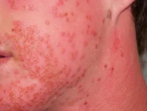 Eczema herpeticum