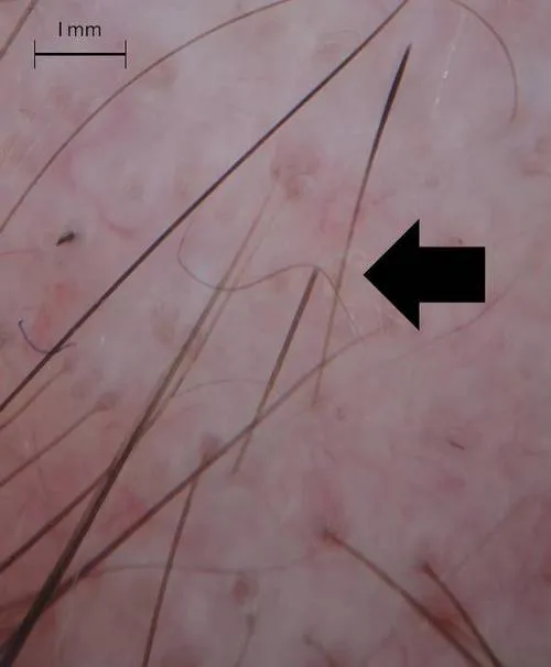 Exclamation-mark hairs in alopecia areata