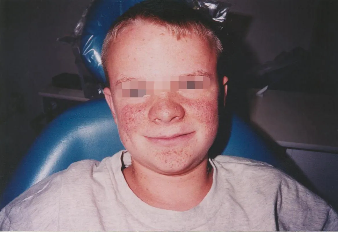 Tuberous sclerosis skin findings
