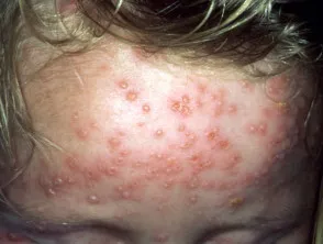 Varicella vesicles