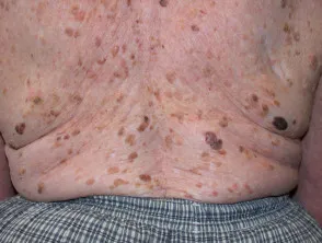 Seborrhoeic keratosis