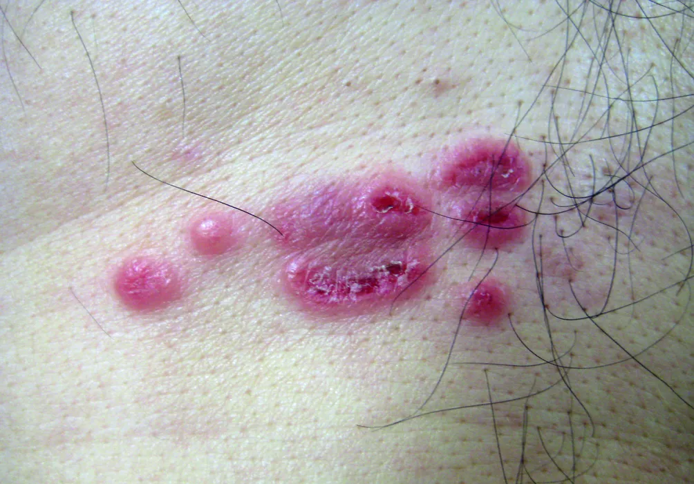 Leukaemia cutis (localised)