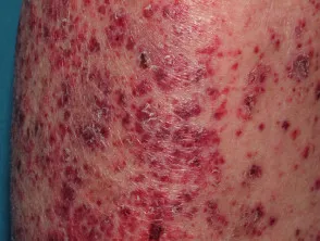 Sjogren vasculitis