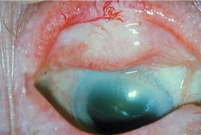 Scarring of the upper inner eyelid and cornea — the superior quarter of the cornea is opacified from scarring