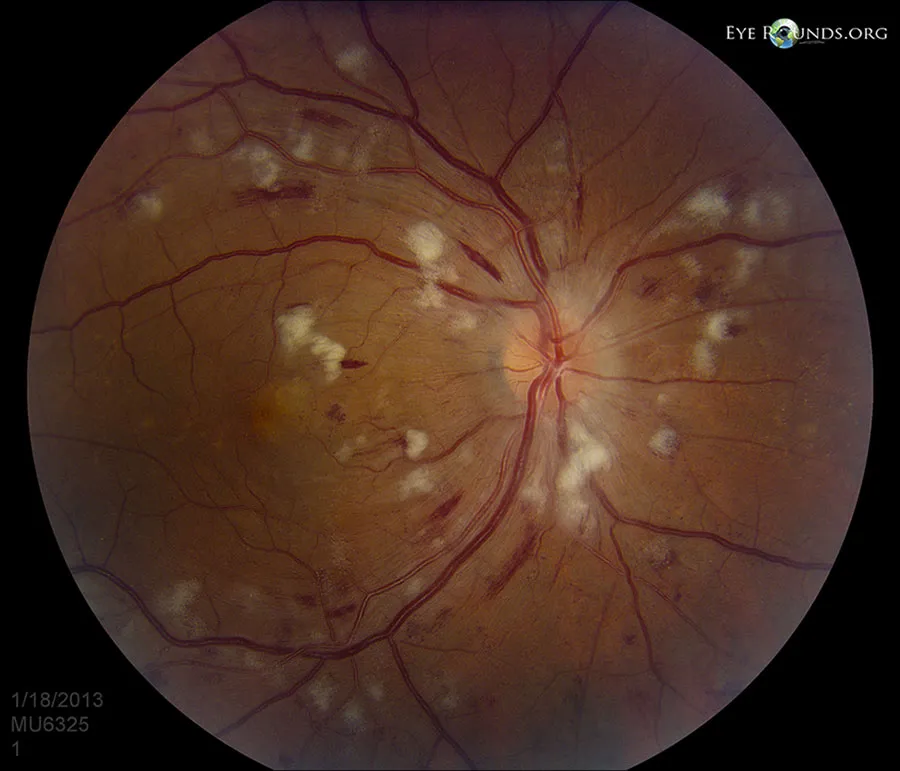 Grade 4 hypertensive retinopathy — extensive haemorrhages, cotton wool spots, optic disc swelling and a macular star of exudates