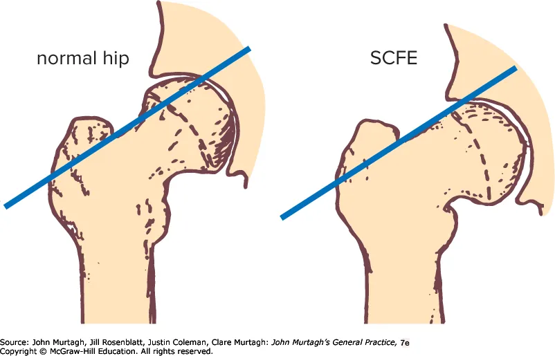 Slipped capital femoral epiphysis — line of Klein