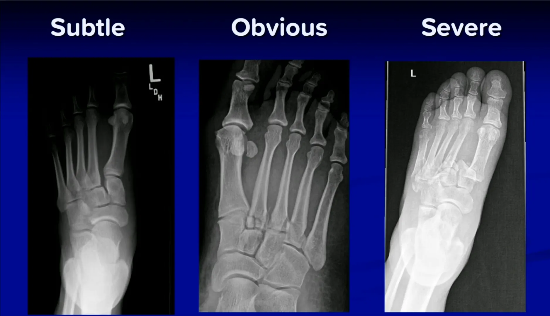 Lisfranc injury — subtle, obvious, and severe