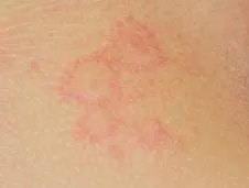 Urticaria examination findings