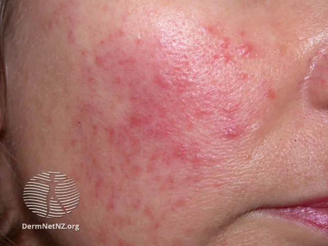 Rosacea