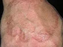 Localised granuloma annulare