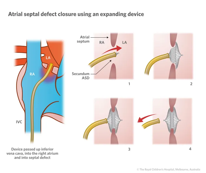 Atrial septal defect anatomy