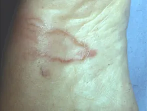 Cutaneous larva migrans