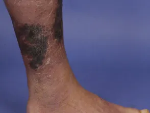 Necrotising fasciitis