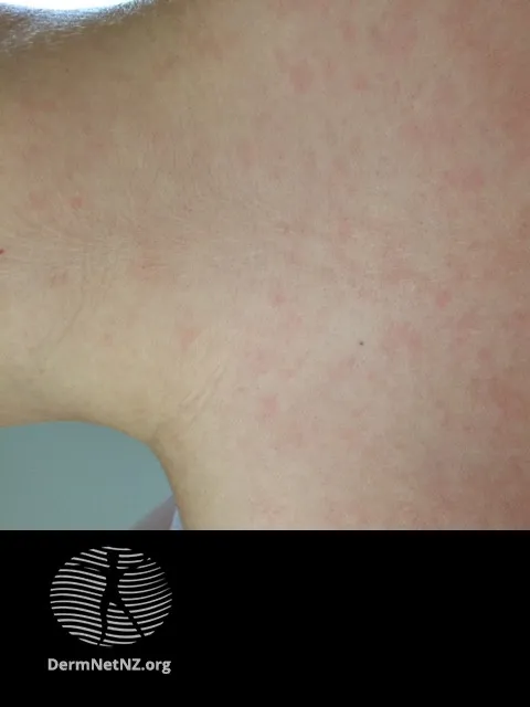 EBV rash plus amoxicillin