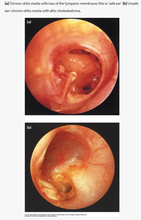 Cholesteatoma otoscopy