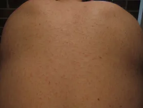 Measles rash