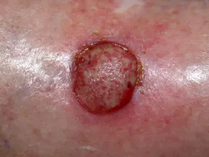 SCC