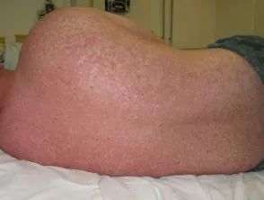 Measles rash