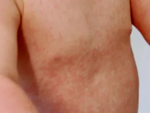 Rubella rash