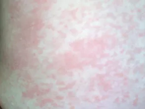 Rubella rash